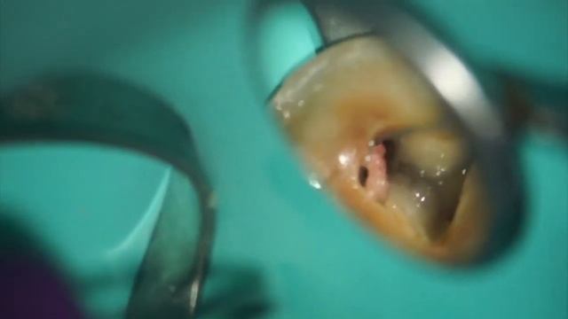 Иван Вьючнов.Lower 2nd molar lasered. смотреть онлайн