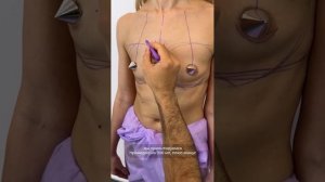 УВЕЛИЧИВАЮЩАЯ МАММОПЛАСТИКА ДОСТУПОМ ПО КРАЮ АРЕОЛЫ. Доктор Карапетян