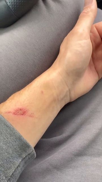 Борщевик обжигает только части тела которые виноваты