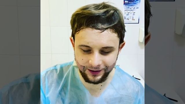 Пересадка бороды киев Dr Sulik