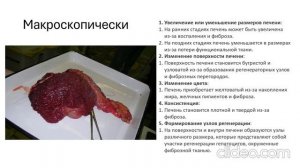 Цирроз печени