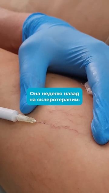НАПОМИНАЕМ, ЧТО У НАС ДЕЙСТВУЕТ АКЦИЯ НА ПРОЦЕДУРУ СКЛ