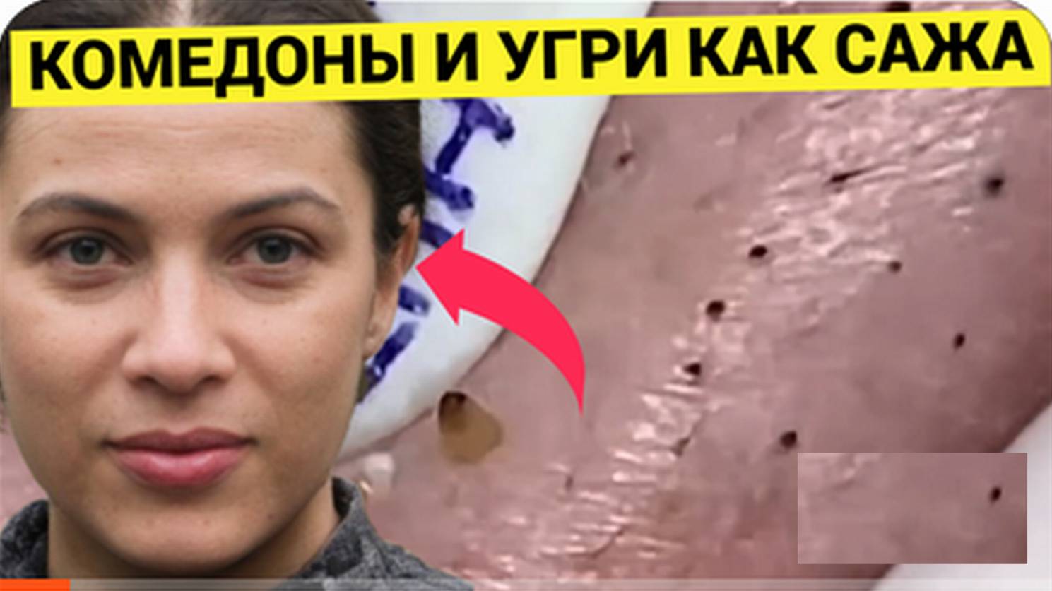 Комедоны КАК САЖА Обсыпали Лицо Молодой Девушки. Или Парня. Так ли это Важно