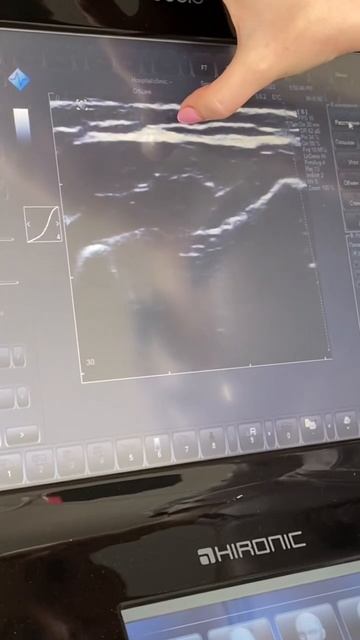 Как работает аппарат для смас лифтинга? В 100med есть уль? смотреть онлайн