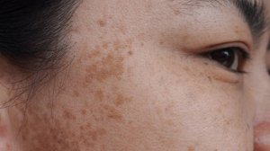 Как избавиться от гиперпигментации