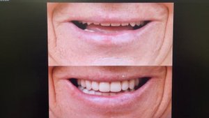 Протезирование зубов. КОГДА делать новые протезы