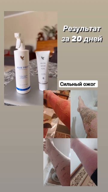 #алоэвера #ожоги #ожог #кипятком смотреть онлайн