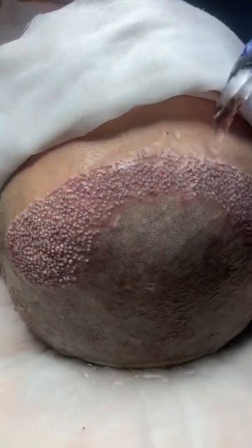 мытье после пересадки волос #пересадкаволос смотреть онлайн