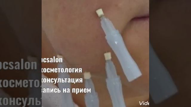 Акция на мезонити|Москва