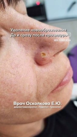 Удаление новообразований кожи