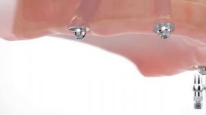 Технология All on 4(1)