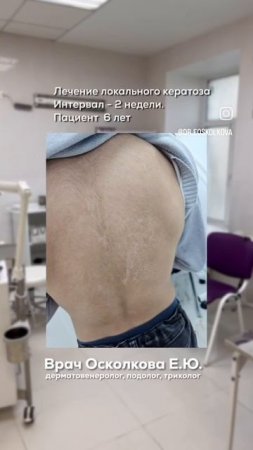 Лечение локального кератоза