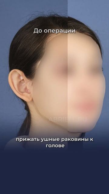 Коррекция лопоухости / Отопластика 👂 от пластическог