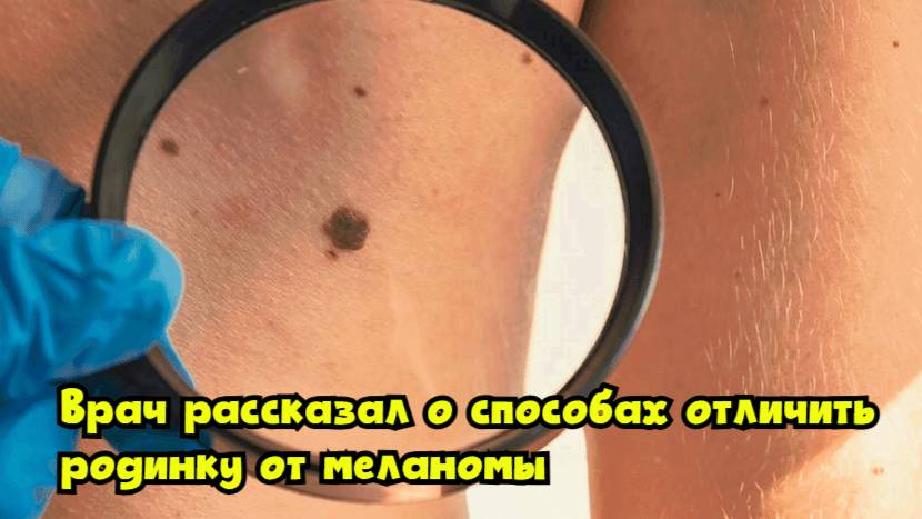 Врач рассказал о способах отличить родинку от меланомы