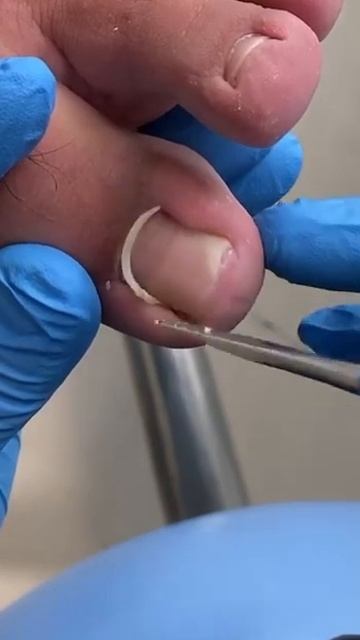 педикюр #валики #онихолизис #онихолизис #подология #по смотреть онлайн