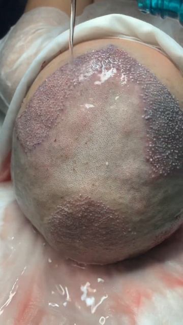 Пересадка волос в Москве #пересадкаволос смотреть онлайн