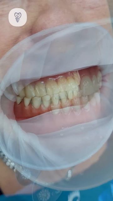 Замена старых протезов на новый прикус. Имплантация З? смотреть онлайн