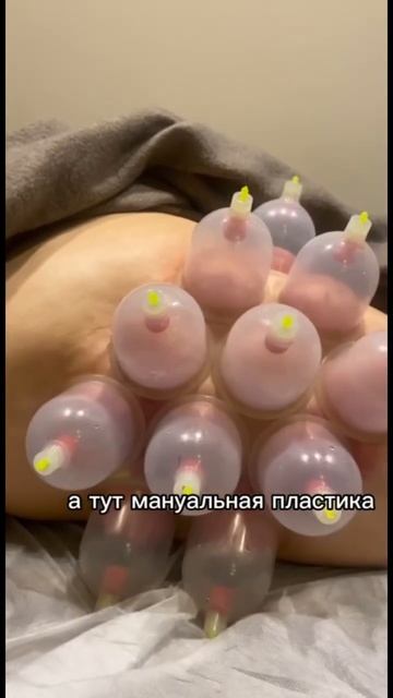 -10 см за 1 процедуру #ручнаялипосакция#ручнаяпластика#?