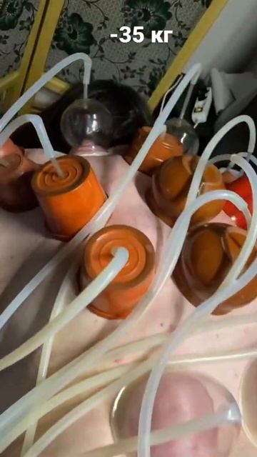 Жиротоп или как похудеть используя вакуумный массаж. ? смотреть онлайн