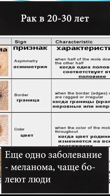 Рак в возрасте 20-30 лет #shorts смотреть онлайн