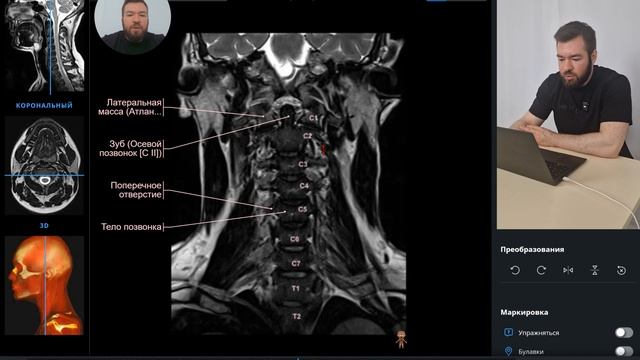 МРТ Шейный отдел. Норма. смотреть онлайн