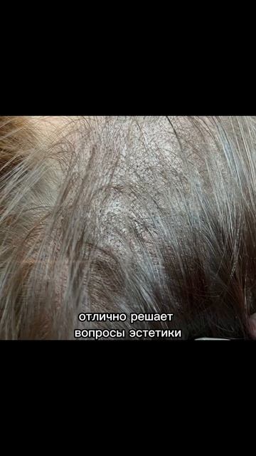 Трихопигментация и пересадка волос #пересадкаволосмо смотреть онлайн