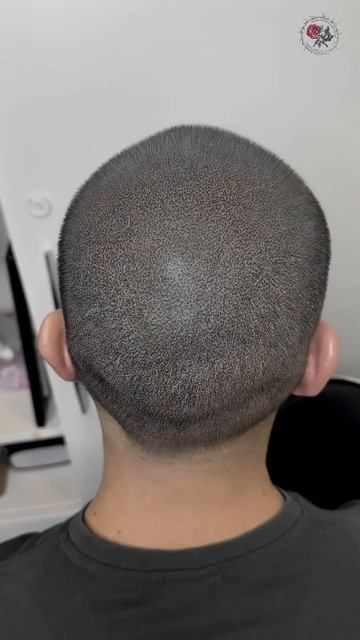 Маскировка шрама после пересадки волос +затылок полно смотреть онлайн