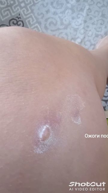 Борщевик.... Последствия ожога, после ядовитого растен? смотреть онлайн