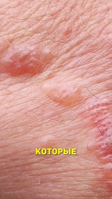 Ожог от борщевика #shorts смотреть онлайн