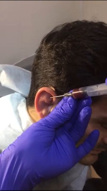 Ухо борца - нагноение.Лор поликлиники "Целитель" смотреть онлайн