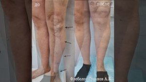 Операция по удалению варикоза на ногах. Варикоз фото до и после операции. Операция без разрезов.