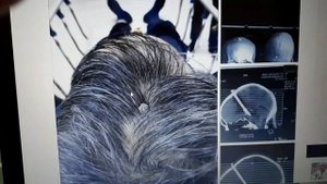 Как вбить гвоздь в голову и выжить? Мужик выжил после попадания гвоздя в голову.