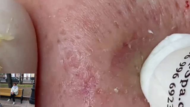 Увлекательное очищение кожи от прыщей смотреть онлайн