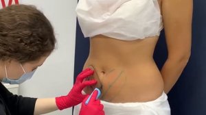 Подготовка к криолиполизу Coolsculpting