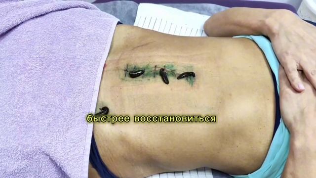 Гирудотерапия после операции: Быстрое восстановление