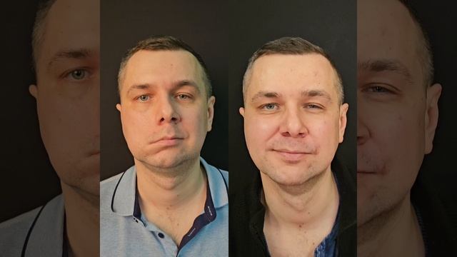 Парез мимических мышц – хирургическое лечение в клинике КЛАЗКО