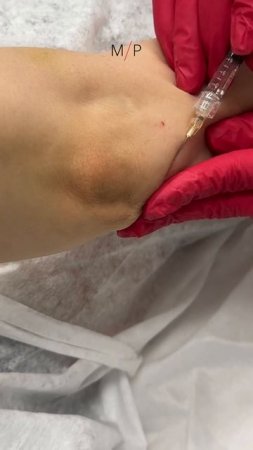Контурная пластика локтей #контурнаяпластика