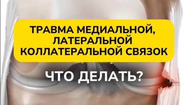 ТРАВМА МЕДИАЛЬНОЙ, ЛАТЕРАЛЬНОЙ И КОЛЛАТЕРАЛЬНОЙ СВЯЗОК: ЧТО ДЕЛАТЬ?