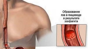 Эзофагит