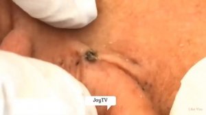 Выдавливание чёрных точек НОВОЕ! Удаление чёрных точе