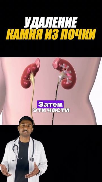 Удаление камней в почках лазером #почки #операция #shorts смотреть онлайн