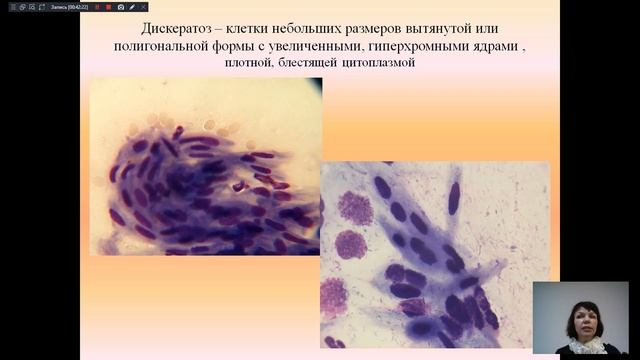 Цитологическая диагностика заболеваний шейки матки -