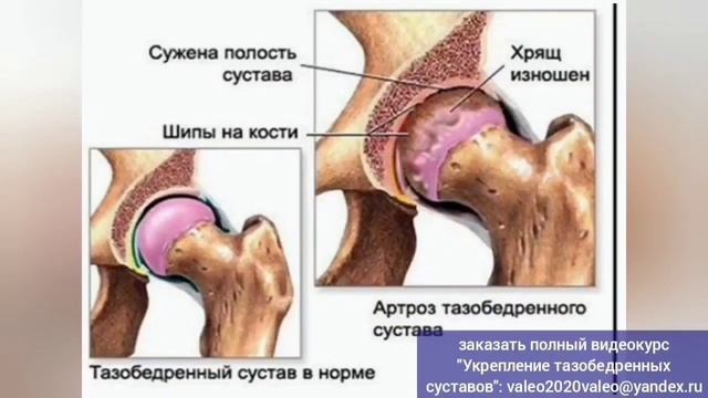 Оживляя тазобедренный ХРЯЩ, укрепляем ДИСКИ ШЕИ. СИНХ?
