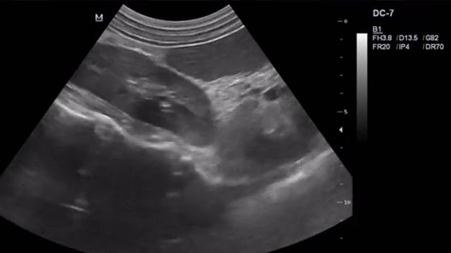 УЗИ надпочечников