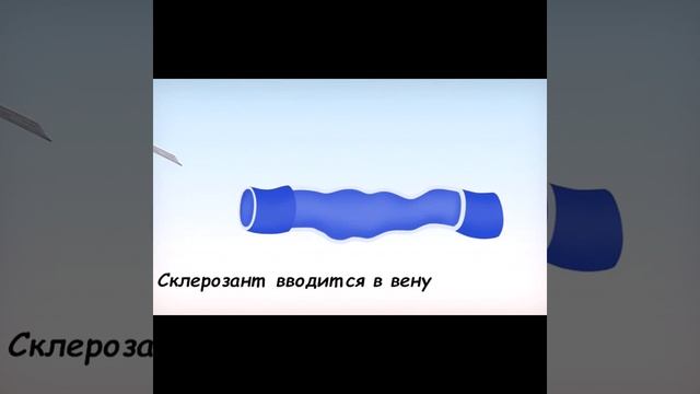 Склеротерапия вен Как работает? Пенная склеротерапия Сосудистые звездочки. Флеболог Алексей Суханов