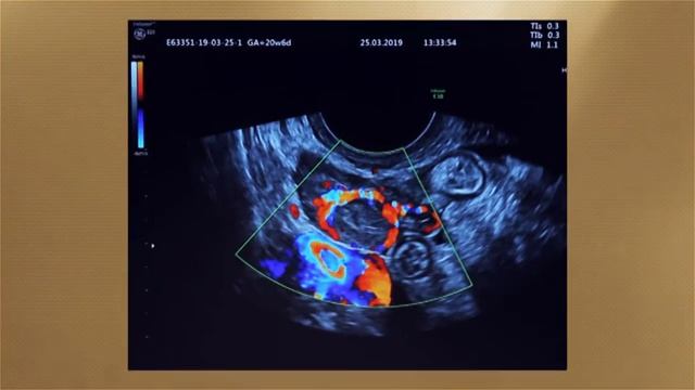 УЗИ МАТКИ И ПРИДАТКОВ