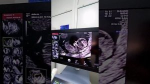 1 триместр. 1 скрининг