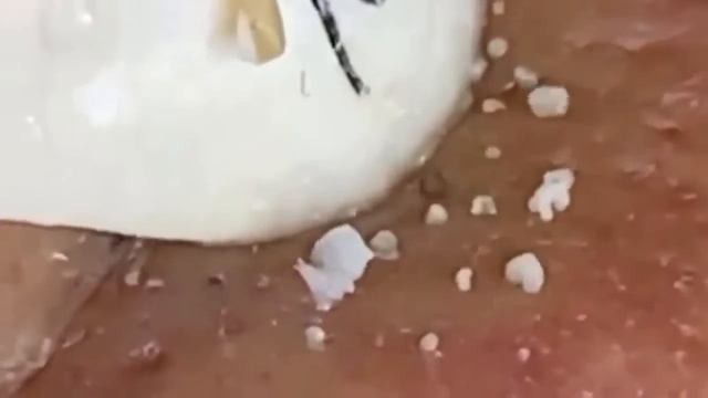 Прыщи  Огромные прыщи  Релакс с акне  Выдавливание пр