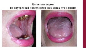 Лекция 1. Заболевания слизистой оболочки полости рта Ч