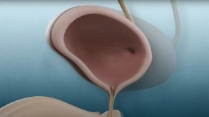 Удаление ПРОСТАТЫ роботом Да Винчи. Лечение рака прос?